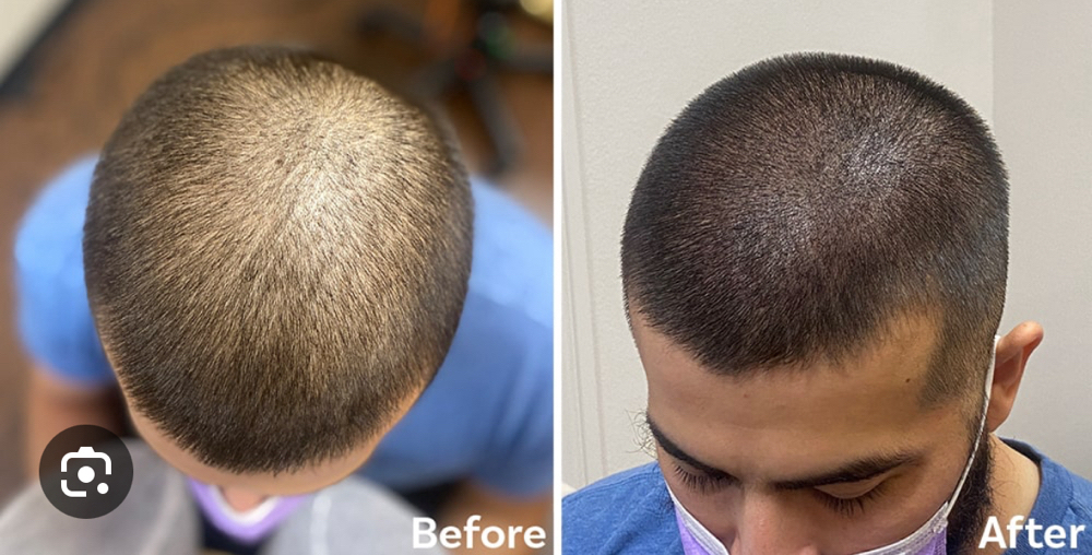 Scalp Pigmentation