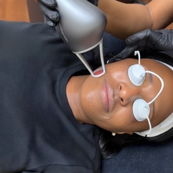 NOUVADERM LASER LITE PACKAGE OF 3 at WilKay Wellness & Aesthetics in Gilbert, AZ