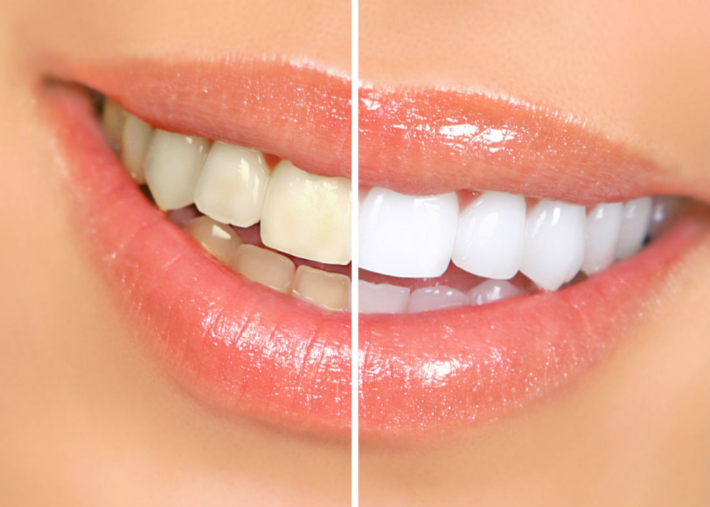 Teeth Whitening 40 Minutes