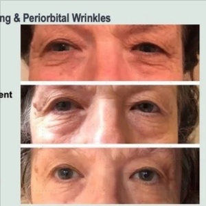 Tixel Eyes Only at Marco Island Aesthetics