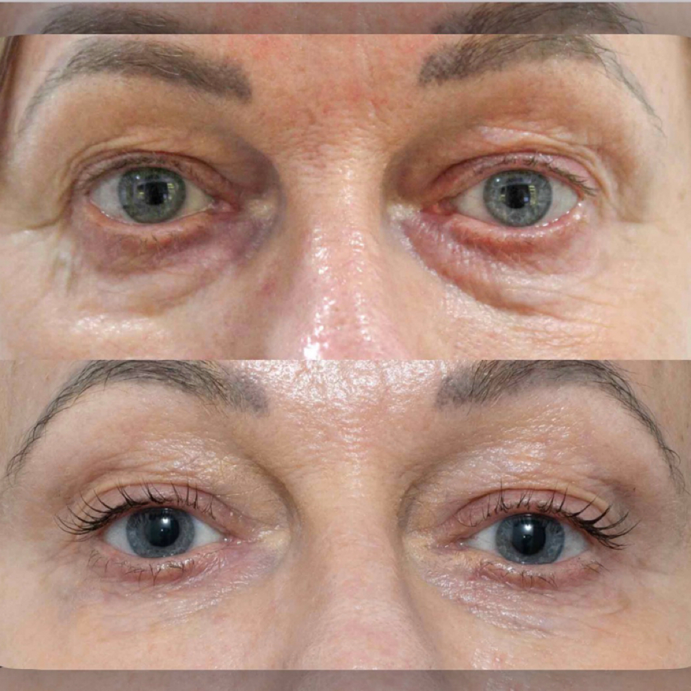 Tixel Eyes Only at Marco Island Aesthetics in Marco Island,, FL