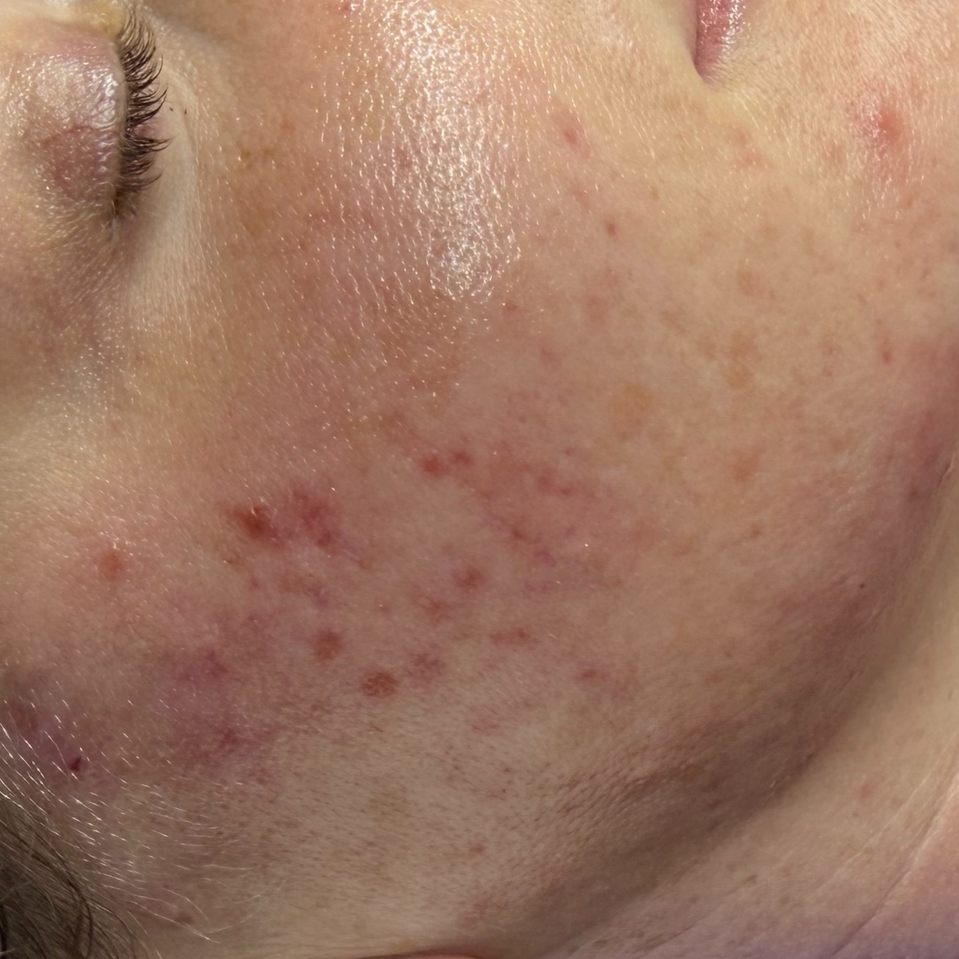 Teen Acne Facial at Skin Corrective Aesthetics in Dallas, TX