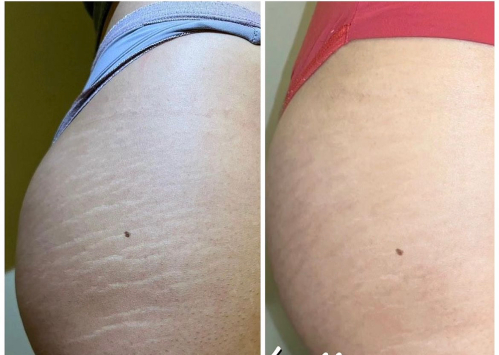 Stretch Mark Rejuvenation