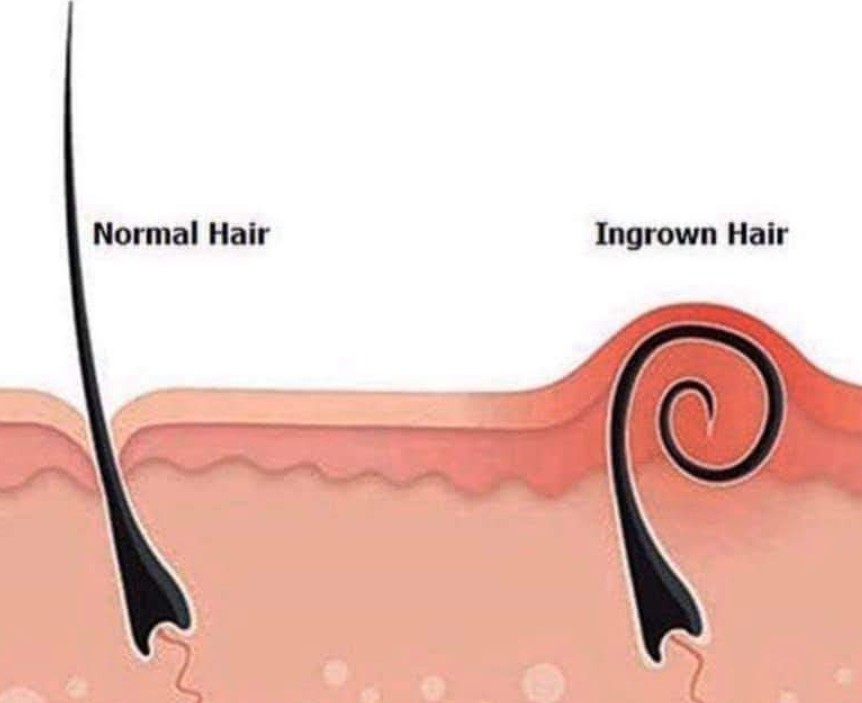 Ingrown Hair Treatment (Add-On)