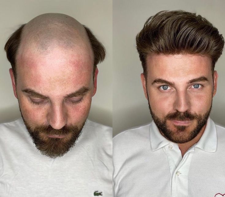 Men's Hair System Placement and Cut