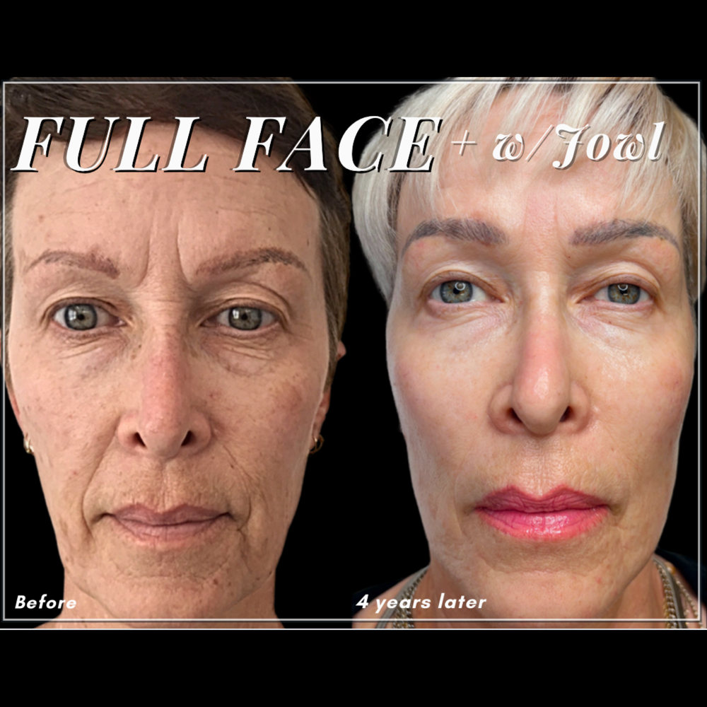Full Face OR Full Face W/Jowl Combo