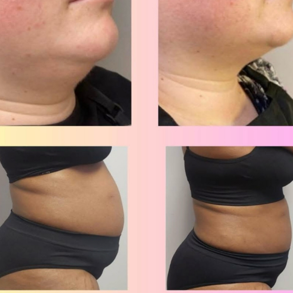 One Tummy Control Session at Finesse Sculpt Body Studio in Parkville, MD