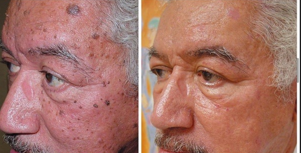 Fibroblast  Face & Neck at International Esthetics Center in Goose Creek, SC