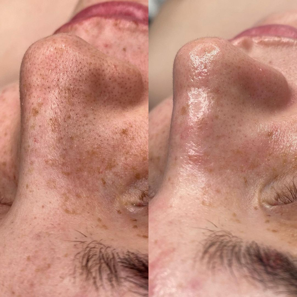 Hydrovitality Facial