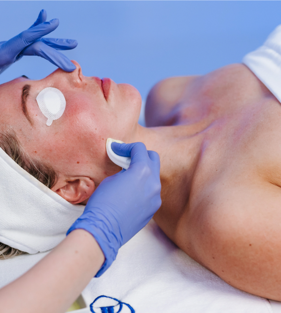 Chemical Peel