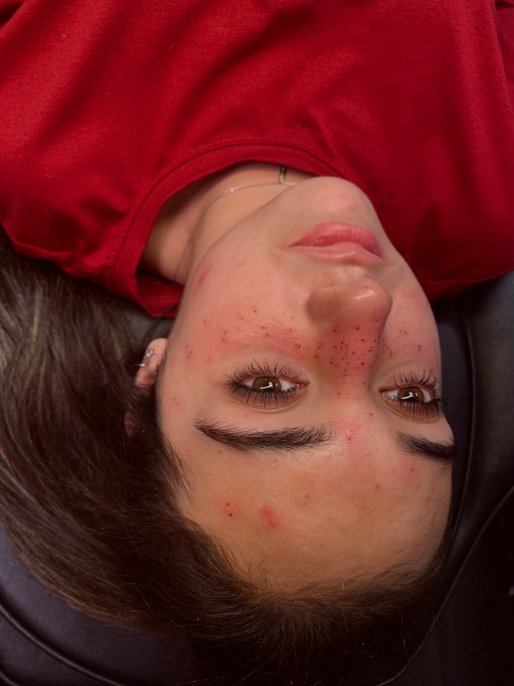 Freckles