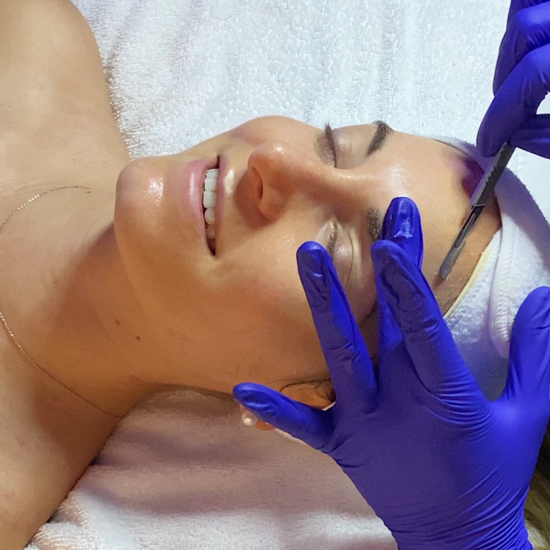 Add On - Dermaplane at Arcadia Esthetics in Plymouth Meeting, PA