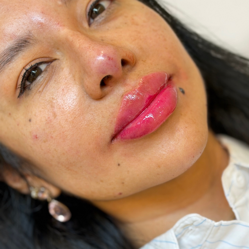LIP FILLER FOLLOW-UP✨ at The Skin Room Med Spa in Marshall, TX