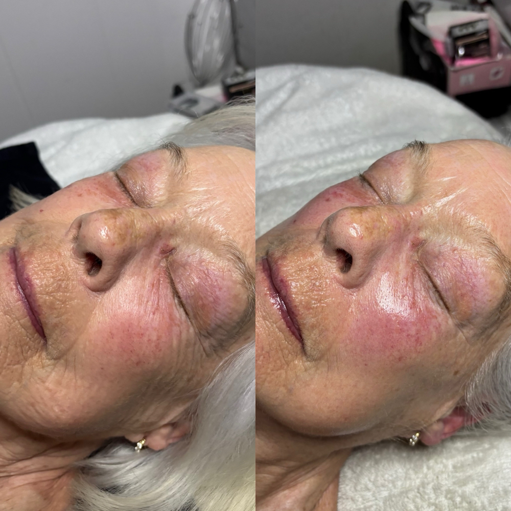 Swich Dermal Revitalization Facial at KateVEsthetics in Milton, DE