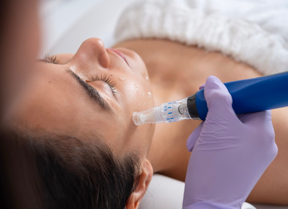 Microneedling