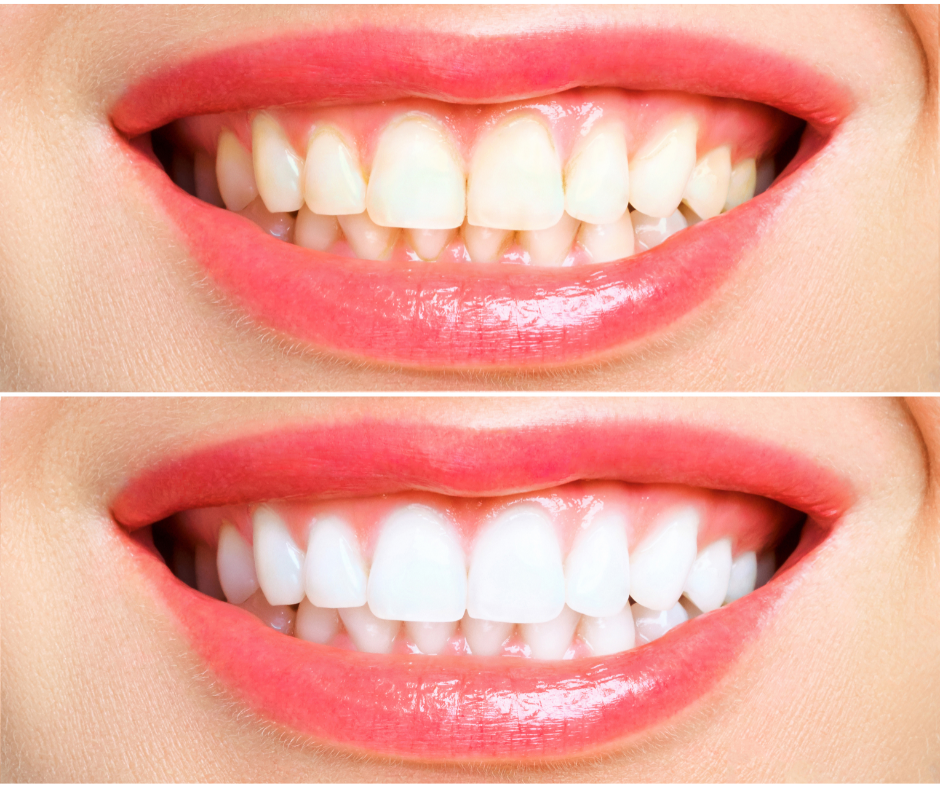 Teeth whitening