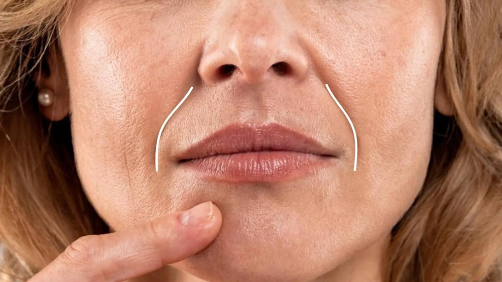 Nasol Labial Folds