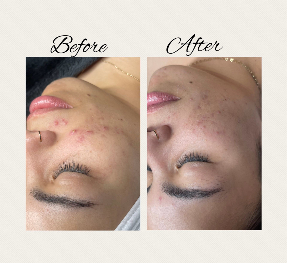 Facial Profundo De Acne Peeling at D&K Beauty&Spa in Newpor News, VA