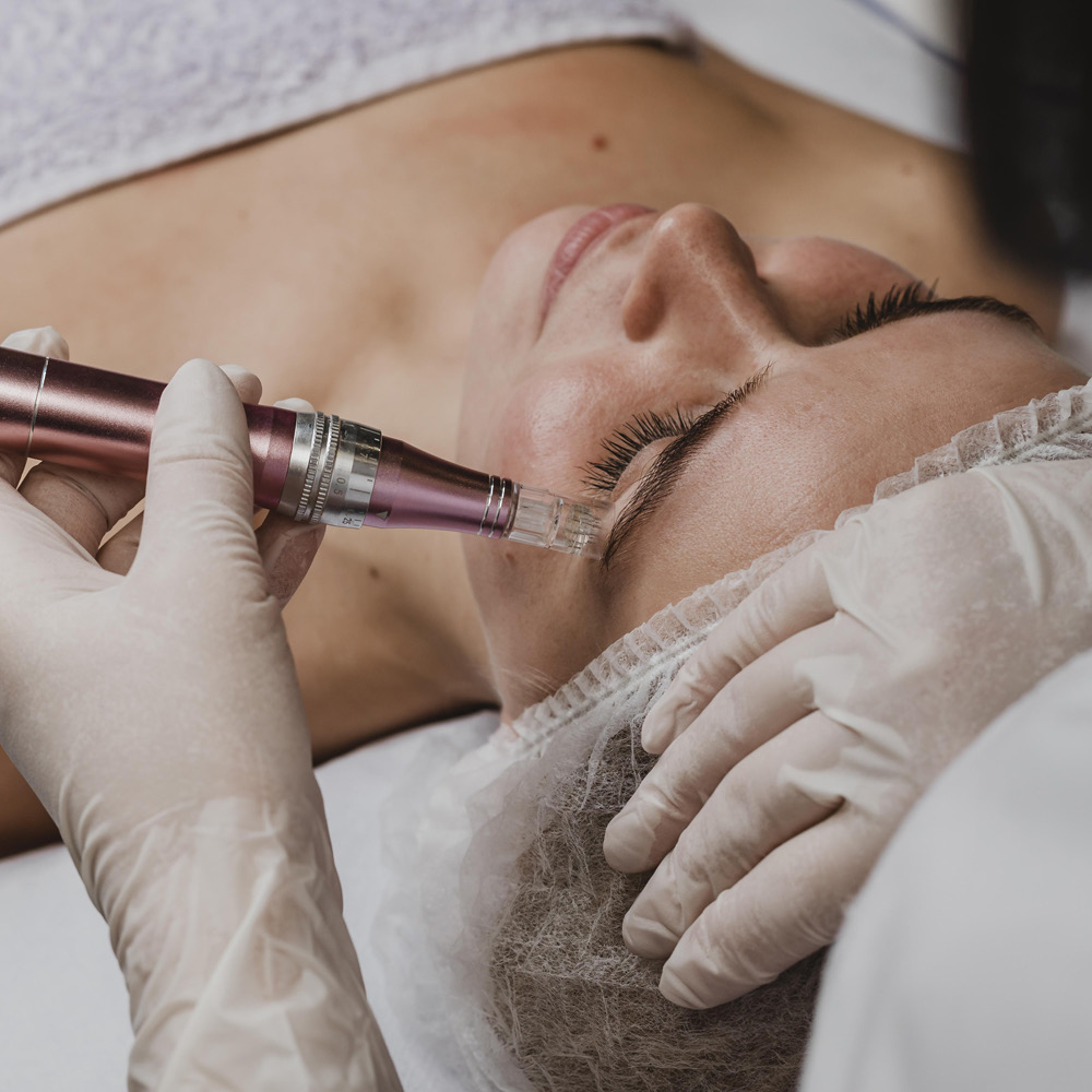 Microneedling