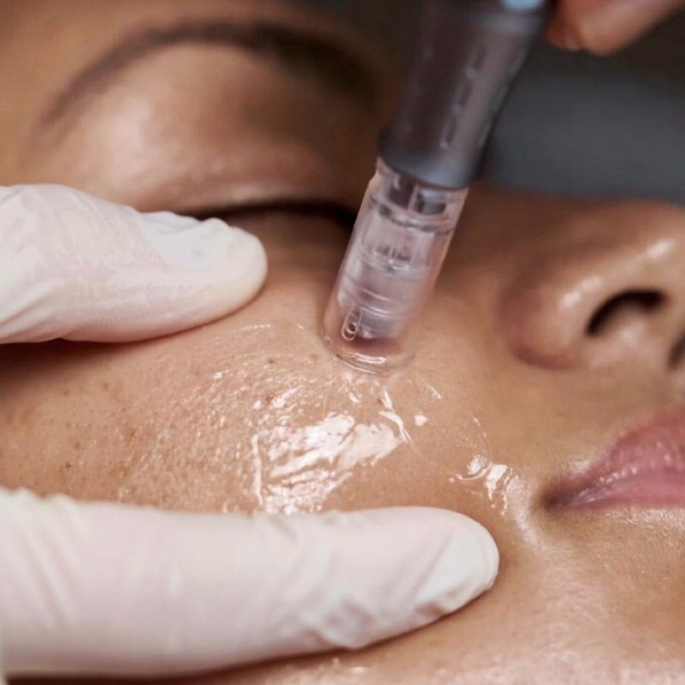 80 Min Nanoneeding  facial at My Favorite Spa in North Carolina, NC