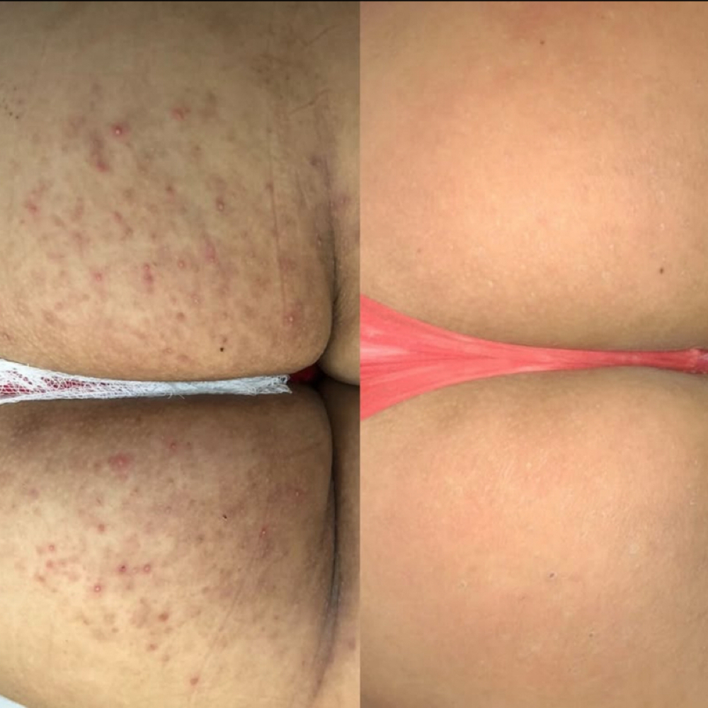 Clareamento De Gluteo at Jessica Luchesi Skin Wellness in Elizabeth, NJ