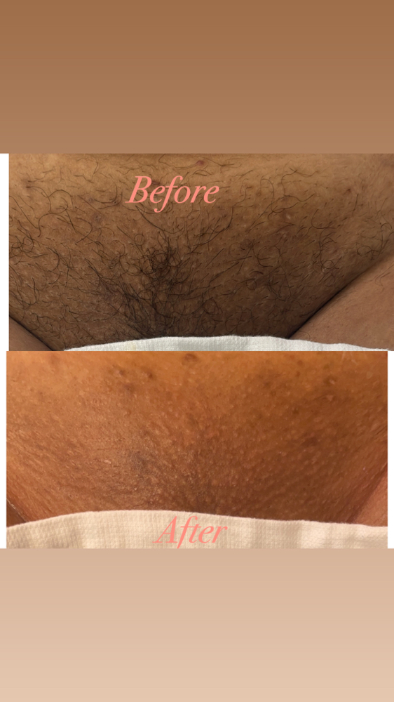 Brazilian Wax