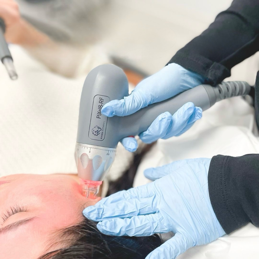 RF Microneedling for Face & Neck