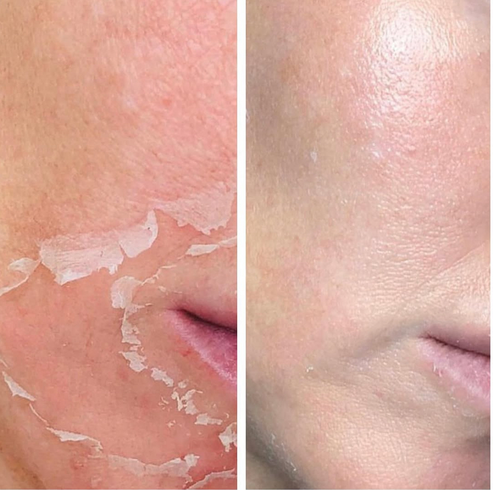 Corrective Peel 2-3 Days Of Peeling