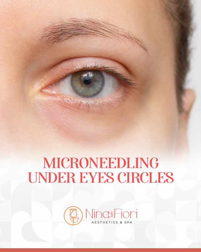 Microneedling Under Eyes Circles