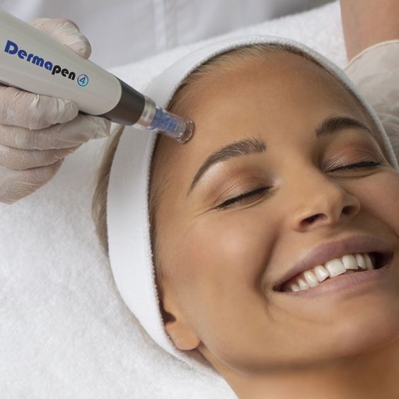 Microneedling