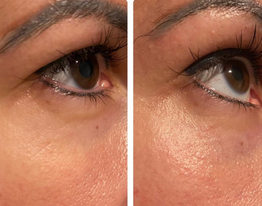 Total Eye/Fibro De Ojo Completo