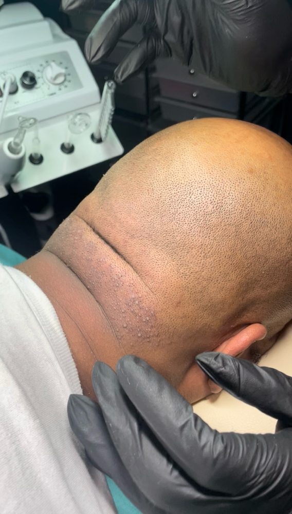 Men’s Neck Treatment