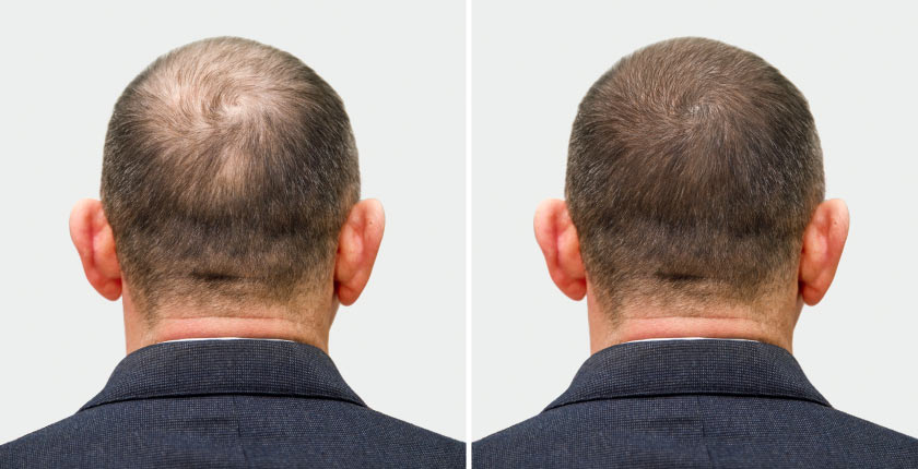 Hair Restoration Procedure