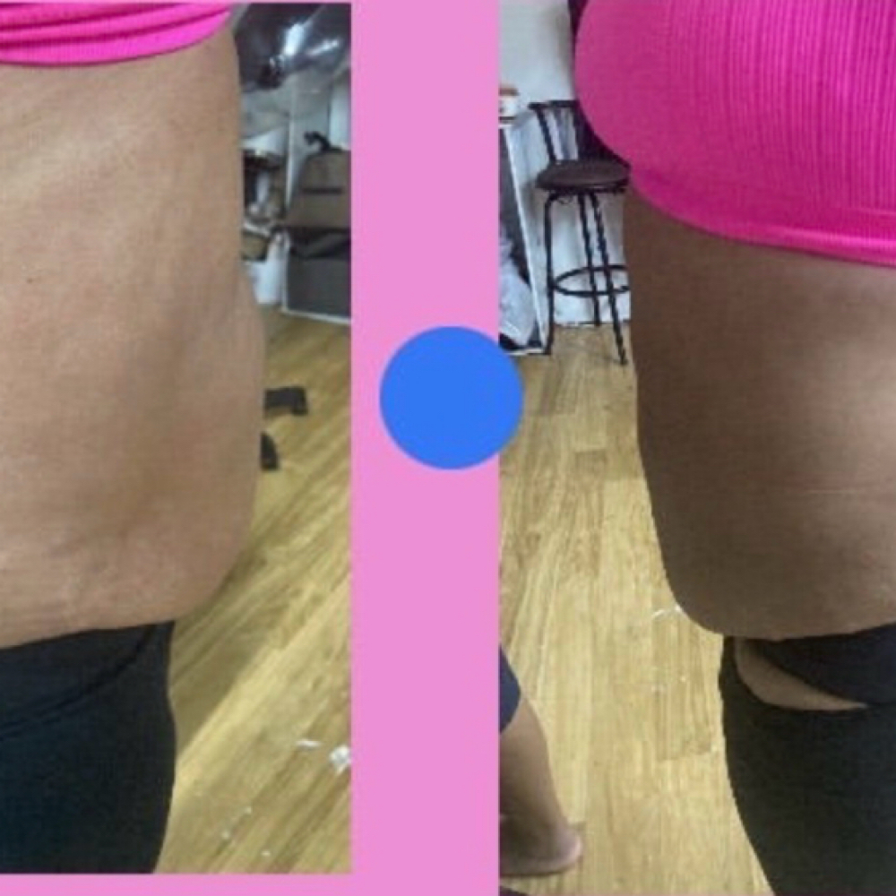 Body Contouring And Firm Your Body at Vshyne Beauty Body Sculpting bar LLC in New Orleans La, LA