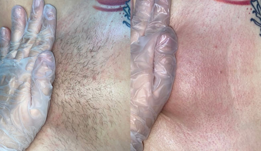 Brazilian Wax