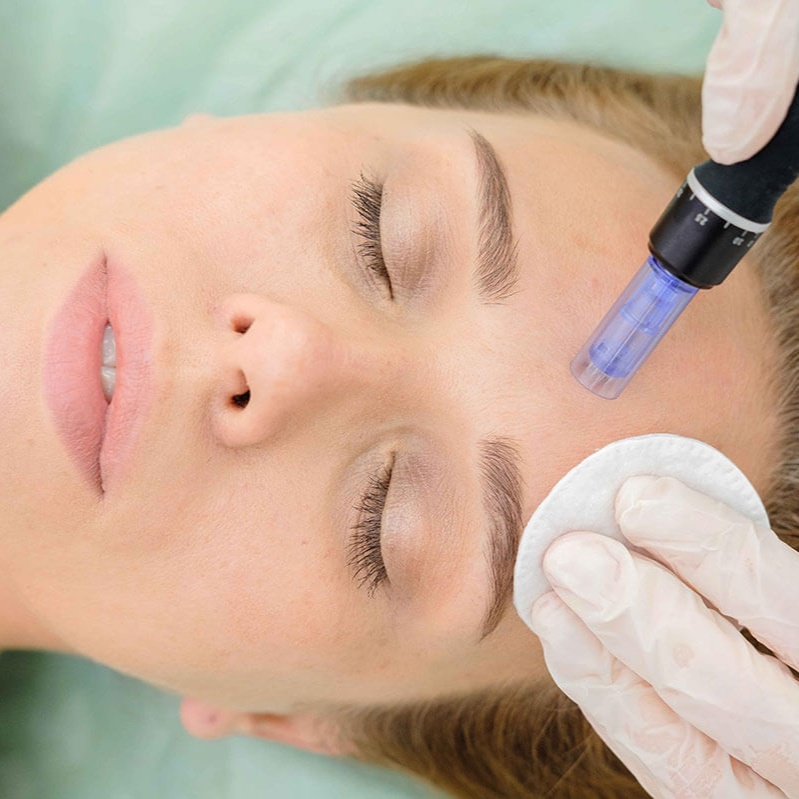 Microneeding Facial at Haus of Glam by Karina J in Haverhill, FL