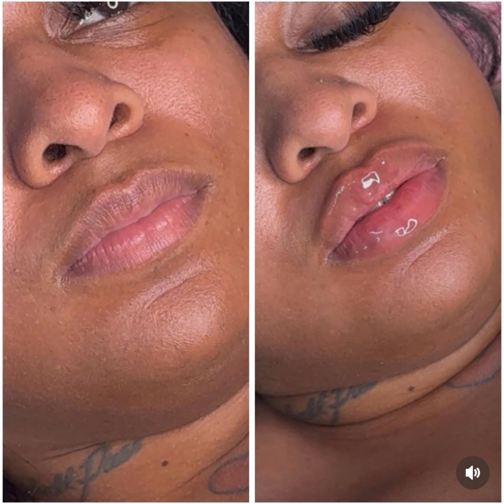 1mL (Restylane Kiss) at Pretty By Princess in Philadelphia, PA