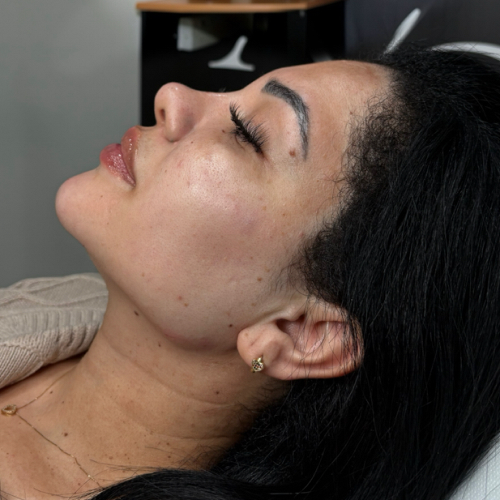 Jawline Filler at Opulence Beaute in Dunwoody Ga, GA