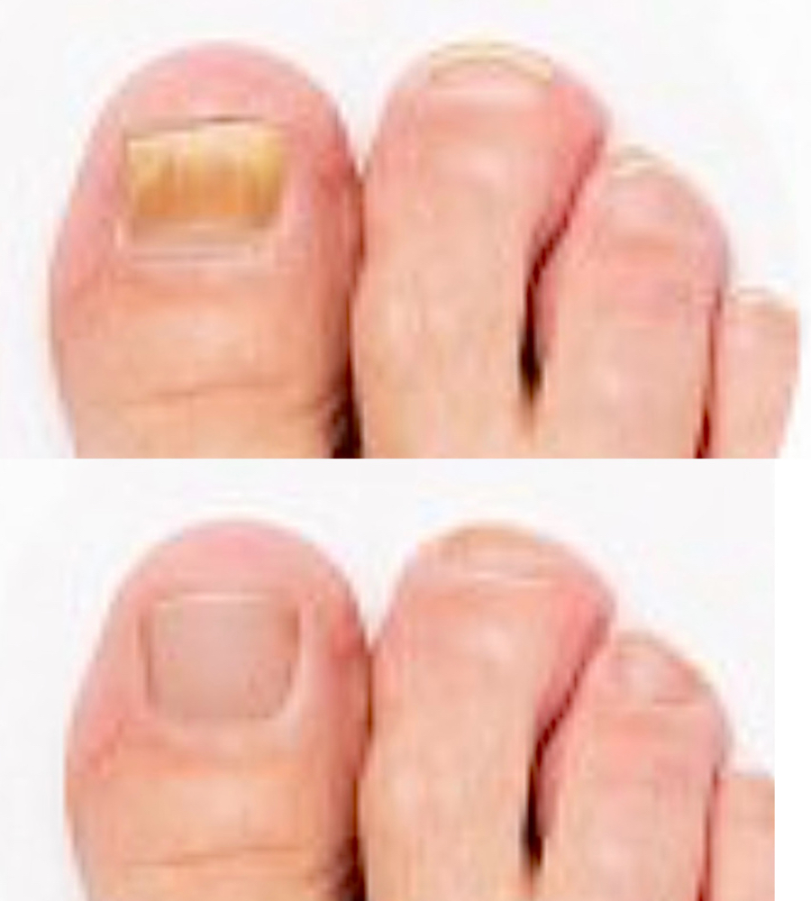 Toenail Fungal Laser Removal PROMO
