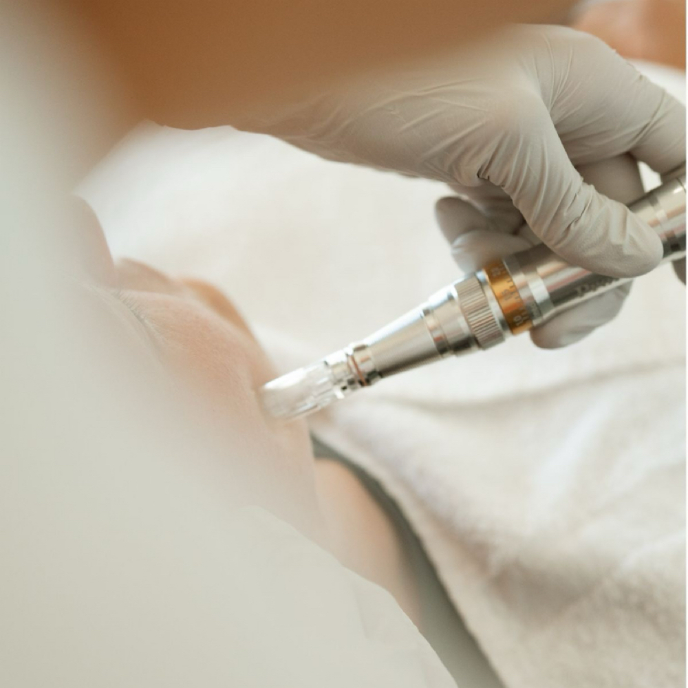 Skin Remodeling Microneedling at Gold’ n Glam Beauty Bar in Casa Grande, AZ