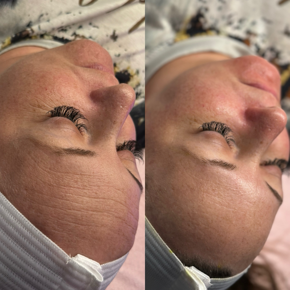 Dermaplane + Lactic Peel + LED