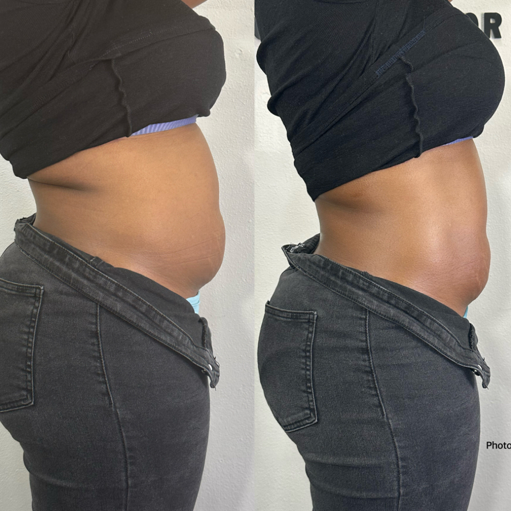 Stomach Sculpt (Cavitation) at Waxxaholics Beauty & Body in Grand Prairie, TX