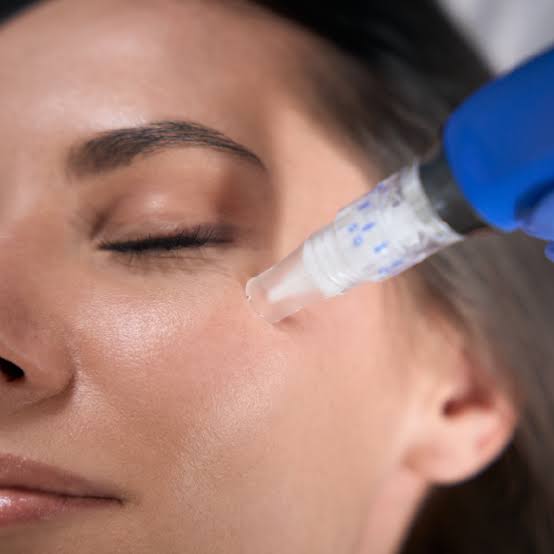 SkinPen Microneedling at KMDEsthetics in Columbus, MS