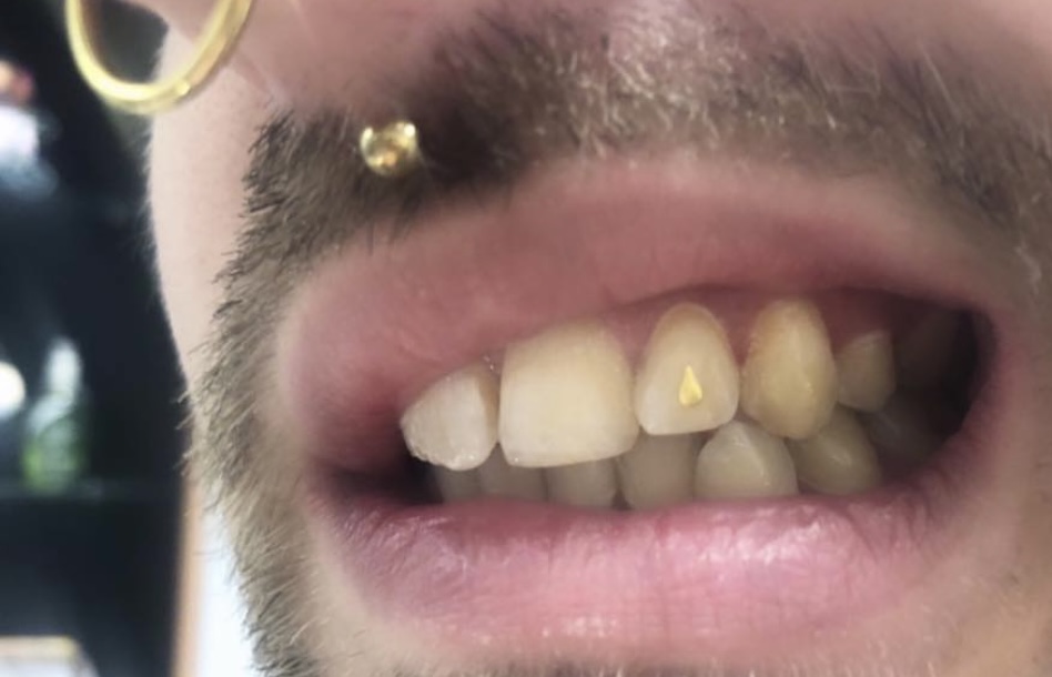 gold shape tooth gem