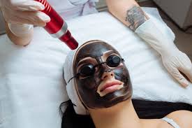 Carbon Peel Laser