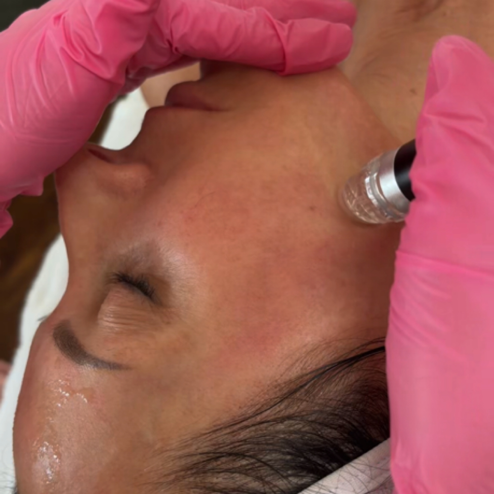 Hydrafacial at Perfectly Imperfect in milan, MO