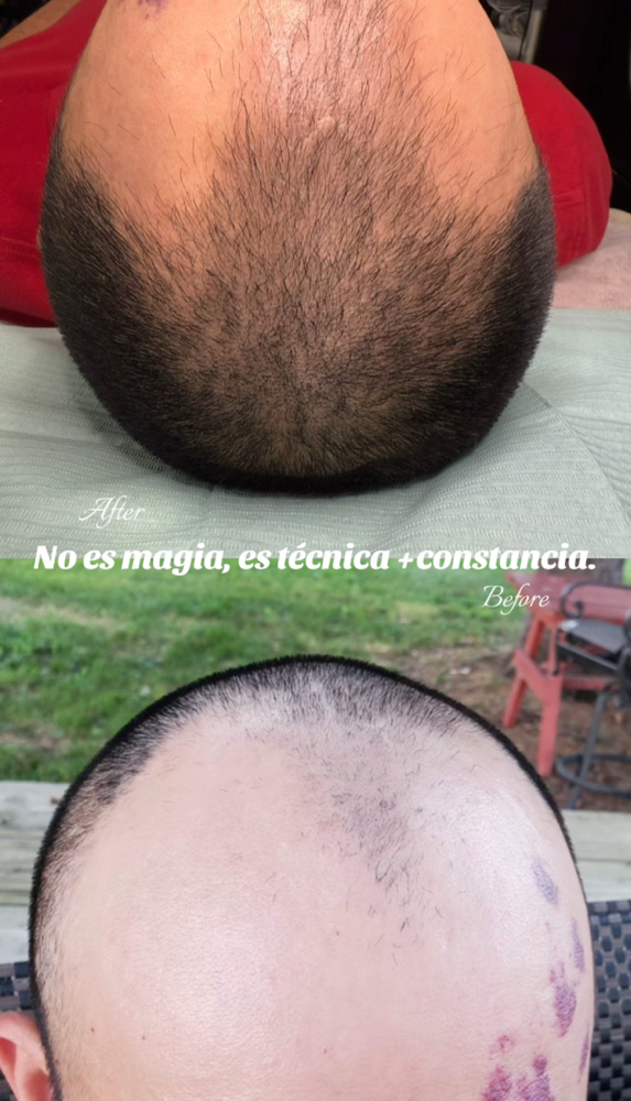 hair  Growth therapy