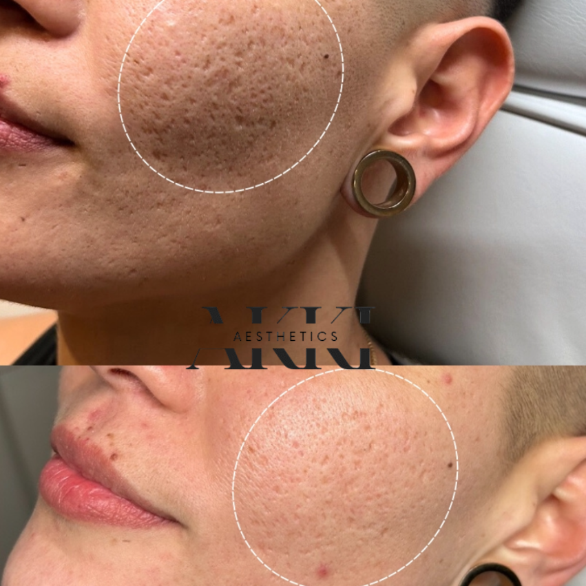 PRP Microneedling at Akki Aesthetics in Williston Park, NY