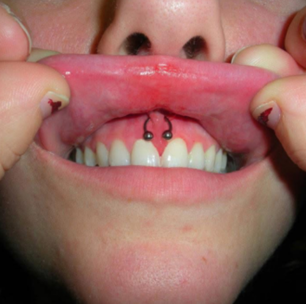 SMILEY (FRENULUM) at Crow & Taper in Hanover, PA