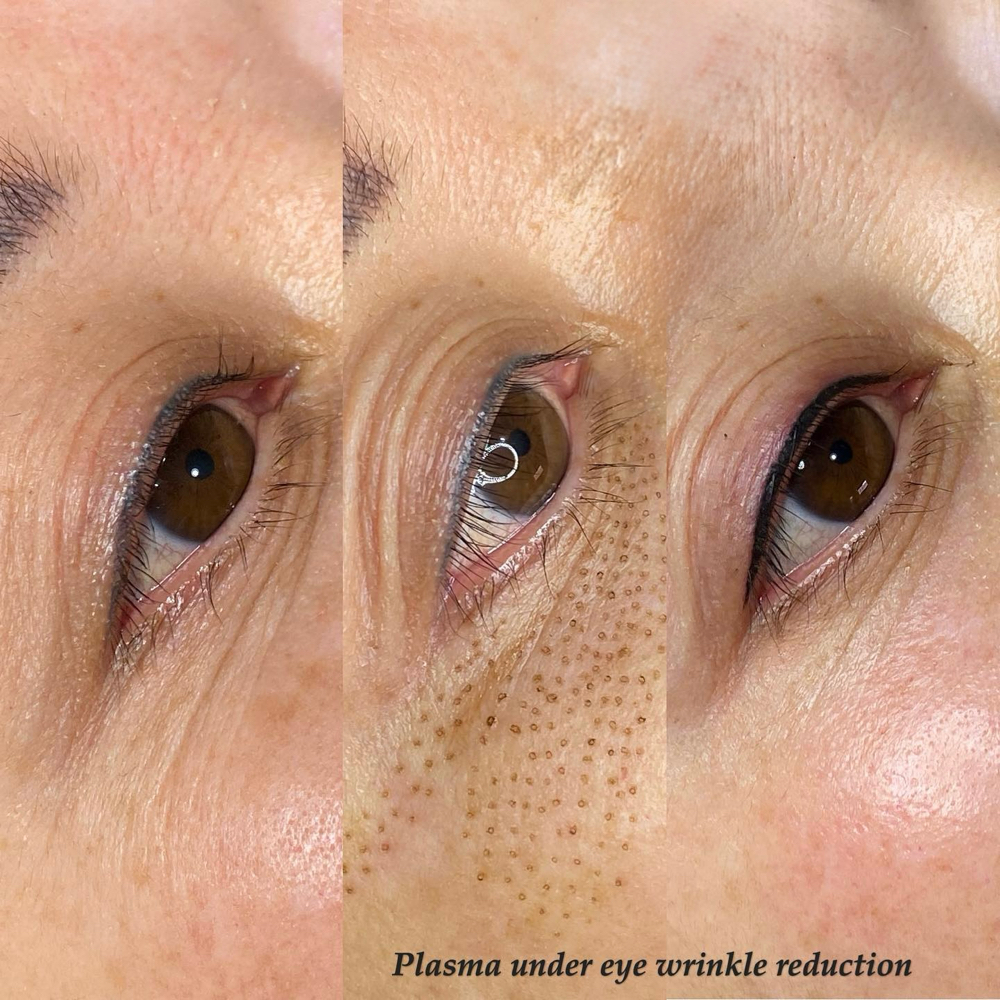 Plasma Fibroblast Eye Circle  Lift